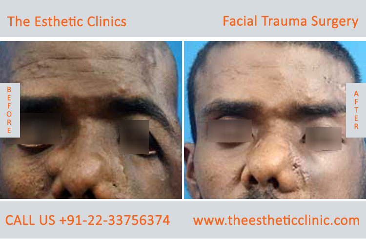 Facial Trauma surgery, Maxillofacial Reconstruction Surgery before after photos in mumbai india (4)